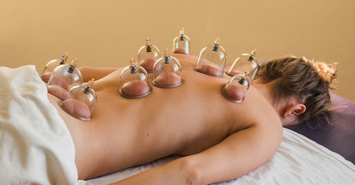 Cupping therapy cups placed on a client’s back.